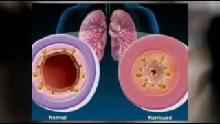 Signs and symptoms of bronchitis Natural herbs treatment of chronic bronchitis [upl. by Lennie712]