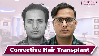 Corrective hair transplant bears fantastic results as it repairs the hairline at Eugenix [upl. by Gare]