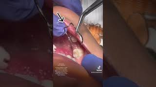 Baby tooth dental Abscess and Band and Loop space maintainer [upl. by Malamut494]