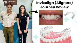 Invisalign Aligners Journey Before and After Review  Invisible Braces  Dental Aesthetics [upl. by Mable966]