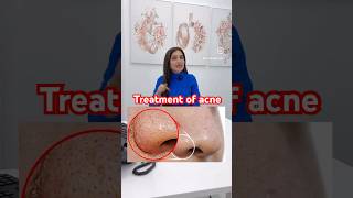 Treatment of acne and white head nose  skincare  skin therapy darkspots ​⁠DrMigraine [upl. by Nogas702]