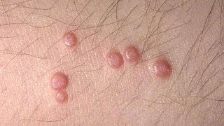 DermTV  Molluscum Contagiosum DermTVcom Epi 445 [upl. by Nirrac]