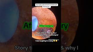 eartubesurgery eartubes adenoidectomy adenoidremoval adenoids eartubesurgery eartubes [upl. by Nryhtak]