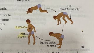 Muscular dystrophies hindi neetpg inicet firstaidusmle [upl. by Web]