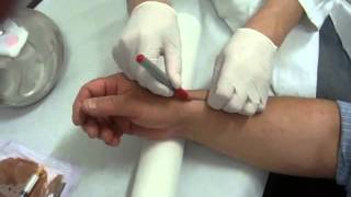 UltrasoundGuided Corticosteroid Injection for the Treatment of de Quervains Tenosynovitis [upl. by Lemuela]