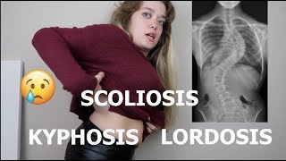 you have scoliosis kyphosis and lordosis [upl. by Santos]