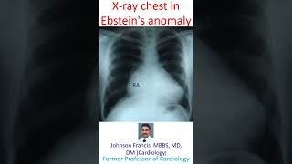 X ray chest in Ebsteins anomaly [upl. by Gerta]