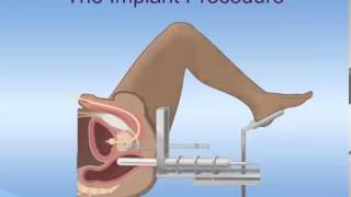 Brachytherapy for Prostate Cancer [upl. by Ashli160]