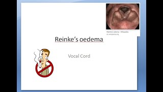 ENT 345 a Reinke Space Edema Oedema Vocal Cord Smoker Voice Horseness Change Treatment Structure [upl. by Felike206]