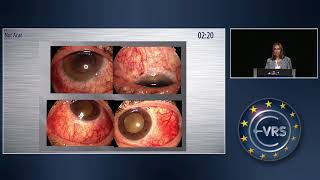 Argus II Epiretinal Prosthesis System Implantation in Endstage Retinitis Pigmentosa [upl. by Berkman]