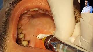 Local Anesthesia Greater Palatine Nerve Block Technique Maxillary anesthesia Techniques dentistry [upl. by Enyrhtac]