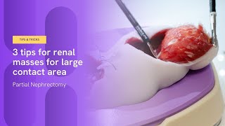 3 tips for renal masses with large contact area  Partial Nephrectomy [upl. by Jehu]