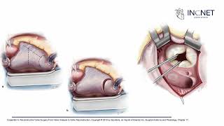 PLASTIA TRICUSPIDEA Y CAMBIO VALVULAR TRICUSPIDEO [upl. by Garbers]