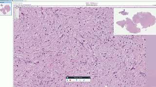 Rosenthal fibers in Pilocytic Astrocytoma  Adventures in Neuropathology [upl. by Idolla397]