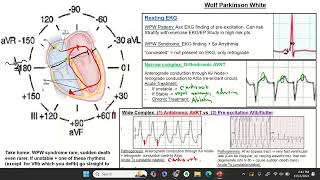 Wolf Parkinson White Syndrome [upl. by Caroline]