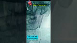 Left Internal Carotid Stenting carotidstenting brainartery heartknowledge cathlab [upl. by Chlo571]