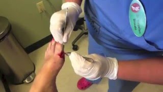 Surgical Removal of Ganglion Cyst [upl. by Adamo591]