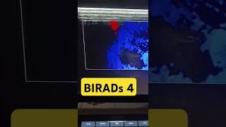 birads breastcancer breast ultrasonography female bass remix radiological radiology [upl. by Helsell]