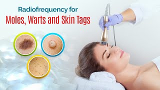 Is Radio Frequency Surgery safe for removing Moles Warts Skin Tags [upl. by White]