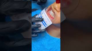 Beautiful process on how to fix fancy teeth braces [upl. by Draw211]