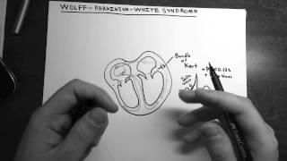 WolffParkinsonWhite Syndrome [upl. by Hudgens]