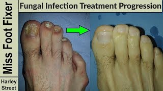 Nail Treatment Progression photo before and after by fungal nail expert [upl. by Hemphill]