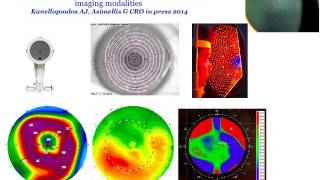 Collagen crosslinking for forme fruste keratoconusIs it indicated [upl. by Birkle9]