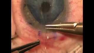 DMEK Cornea Transplant Surgery  Riverwoods Eye Center Provo UT [upl. by Deppy]