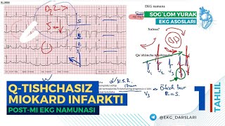 EKG Tahlili01  QTishchasiz Miokard Infarkti  PostMI EKG Namunasi [upl. by Teodora858]