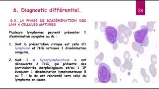 Hemato 13Leucémie lymphoide chronique LLC Dr Abbadi [upl. by Naggem]