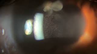 The best video of cells in the anterior chamber [upl. by Atilol]