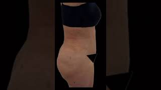 abdominoplastialipolatino [upl. by Ahsiak]