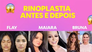 RINOPLASTIA ANTES E DEPOIS [upl. by Alia]