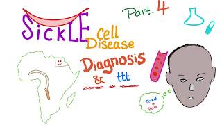 Sickle Cell Disease “part 4” Diagnosisamp treatment [upl. by Colier]