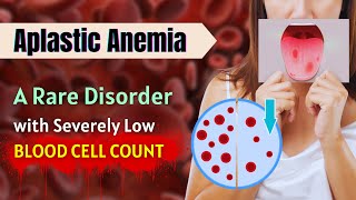 Aplastic Anemia A Rare Disorder With Severely Low Blood Cell Count [upl. by Cioffred]