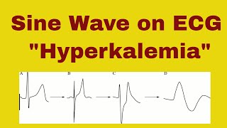 Sine Wave on ECG in Hyperkalemia  Hyperkalemic Periodic Paralysis [upl. by Melony]