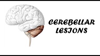 Cerebellar Lesions  Clinical Examination for Cerebellar Examination [upl. by Jagir467]