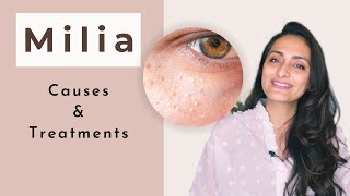 Milia  What is milia  Causes Treatment  dermatologist  Dr Aanchal Panth [upl. by Akerboom63]