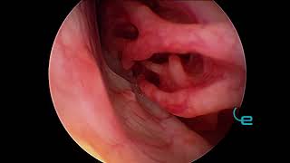 Rhinoscopy leishmanosis in Border Collie Nasal Granulomatosis [upl. by Bill]