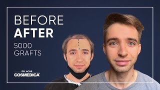 Hair Transplant in Turkey  Hair Transplant Results of Cosmedica [upl. by Sirad]