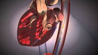 Cardiologie  TAVI Procedure EdwardsXT [upl. by Slavic]