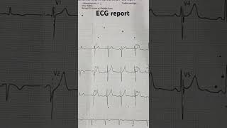 ECG Report shorts viralvideo ytshorts amazing doctor doctorsupari [upl. by Gahl141]