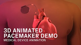 Pacemaker Product Demo  Medical Device Animation [upl. by Zehcnas]