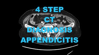 How to diagnose Acute Appendicitis on CT in 4 Steps  Radiology Medical Imaging Pearls Tips Tricks [upl. by Fabron]