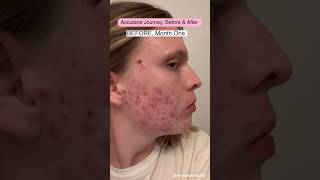 I FINISHED ACCUTANE🤩 [upl. by Riatsila]