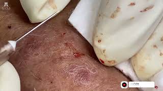 Big Cystic Acne Blackheads Extraction Blackheads amp Milia Whiteheads Removal Pimple Popping 2024 [upl. by Nroht]