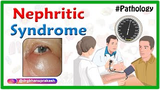 Overview of Nephritic Syndrome  Nephrotic vs Nephritic Syndrome  USMLE Step 1 [upl. by Naarah431]