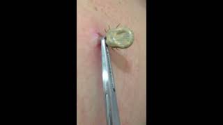 Tick removal by US doctor [upl. by Akiaki]