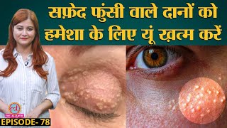 Milia यानी Skin पर सफ़ेद फुंसी वाले Pimples को आसानी से खत्म करने का तरीका  Sehat ep 78 [upl. by Eleanor]