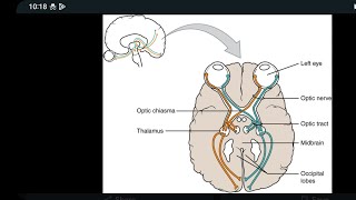 Mystery diagnosis Sepio Optic Dysplasia [upl. by Karleen]